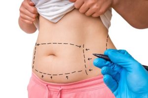 Is a Tummy Tuck Permanent