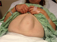 Sparkles and Lattes: Diastasis Recti and Umbilical Hernia Repair Surgery