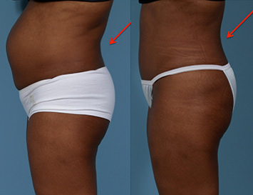 Hernia Rectus Diastasis Repair Before and After