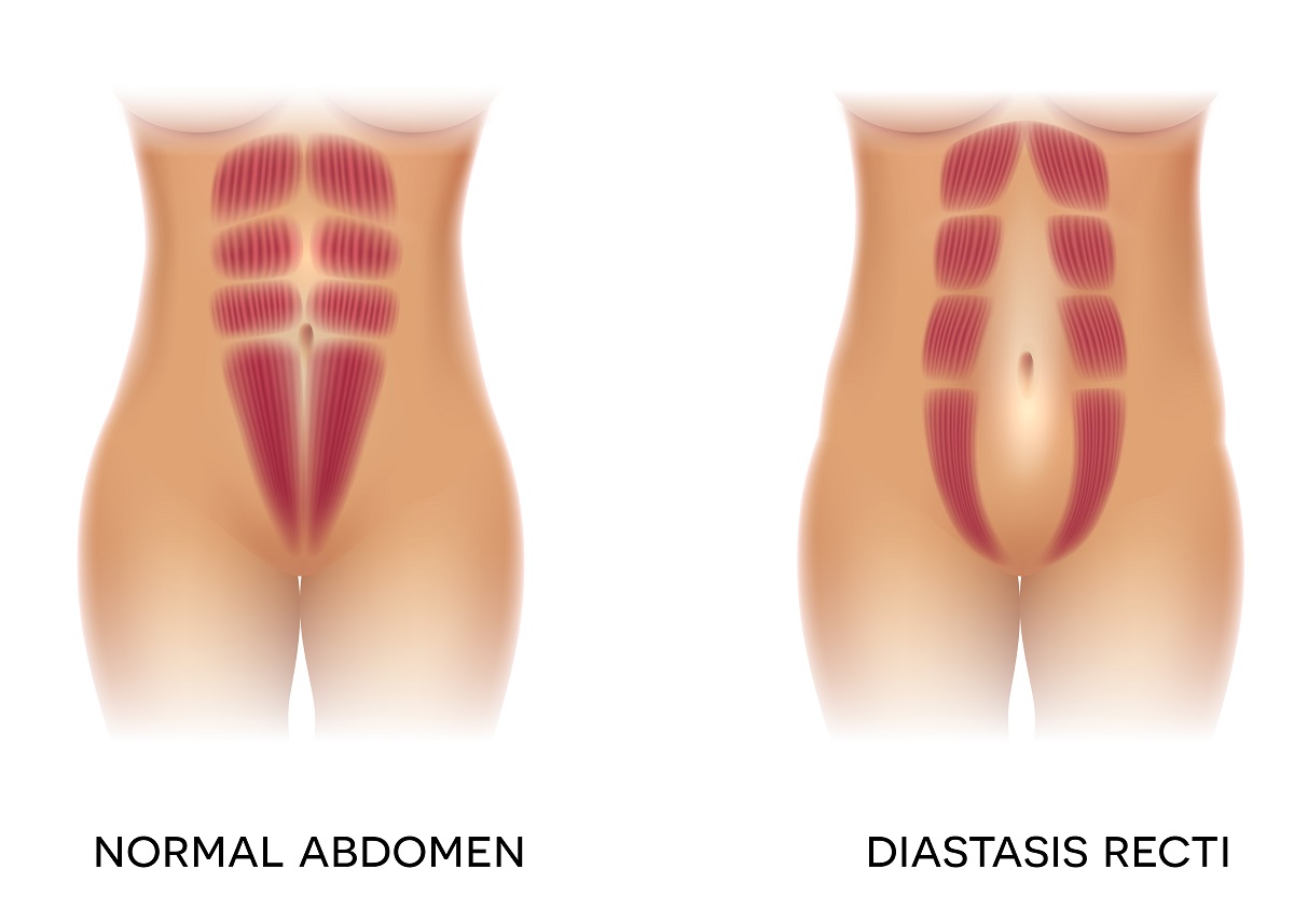 What Causes Rectus Diastasis?