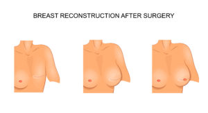 Breast Reconstruction Chicago