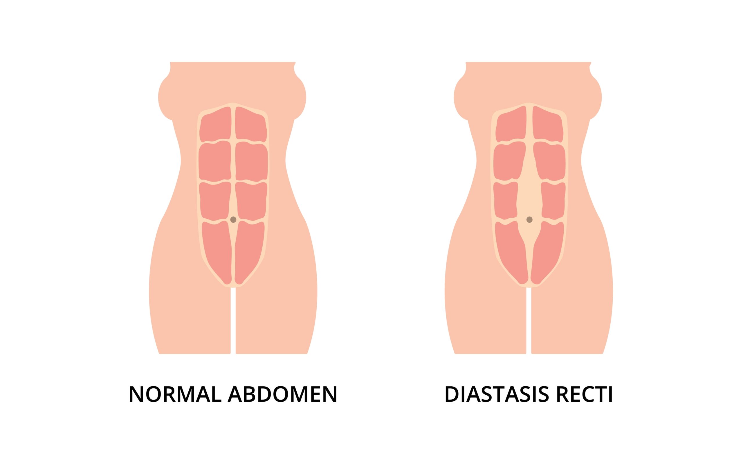 Abdominal Separation- How to tell if you have it and what to do
