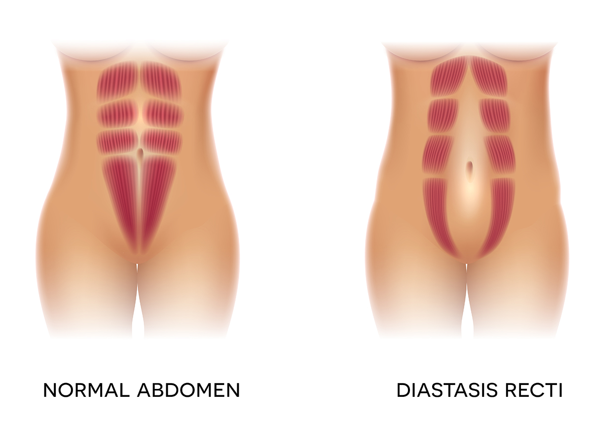 Diastasis recti vs Hernia - How To Know The Difference?