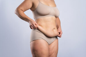 Woman with draping folds of belly skin lifts it up in despair before her tummy tuck