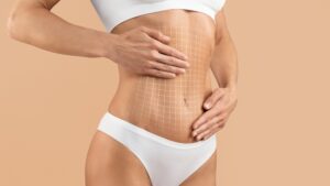 Woman touches her toned, sleek abdomen after a tummy tuck with mesh abdominal muscle repair