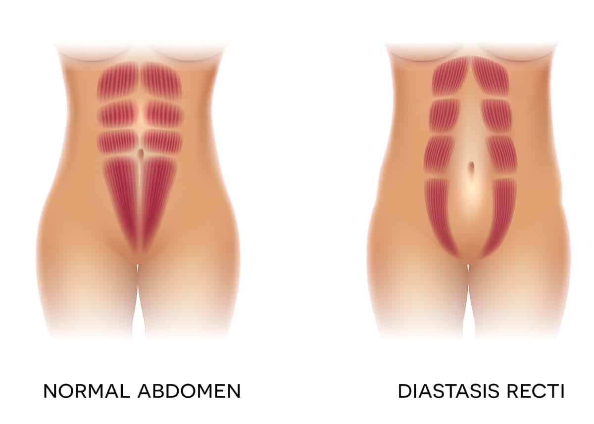 Abdominal Muscle Separation Chicago, IL