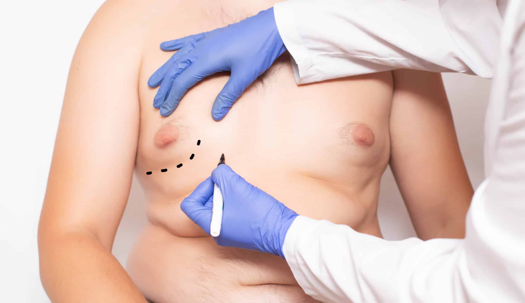 Gynecomastia Chicago