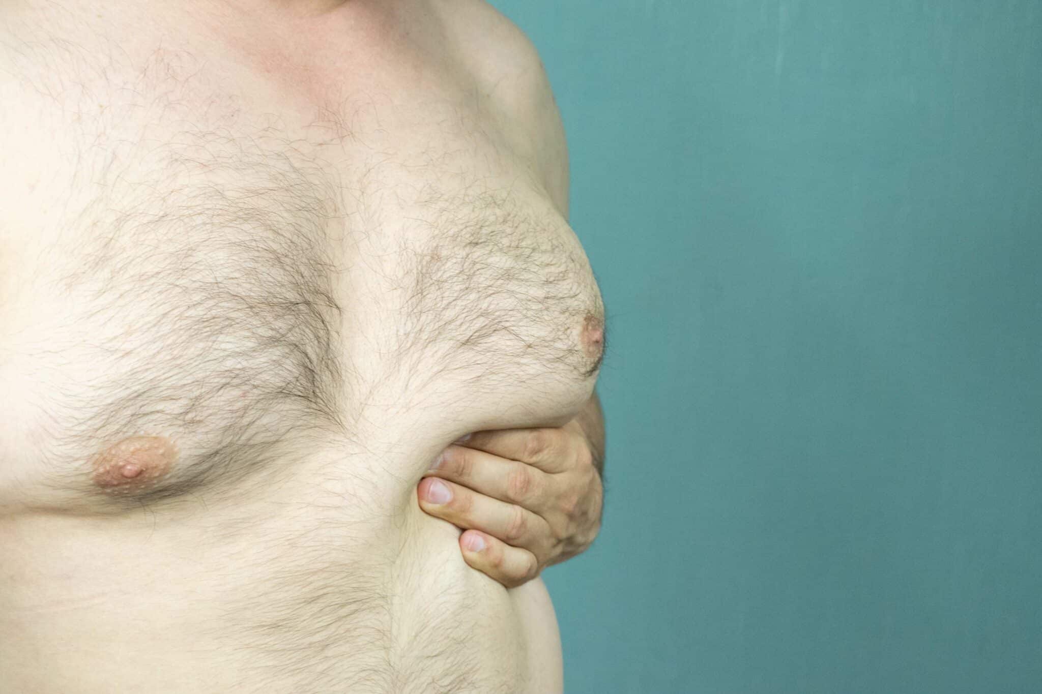 Bare-chested man pinches excess chest skin, showing gynecomastia