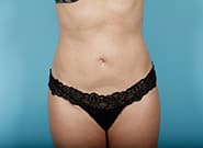 After Image: Abdominoplasty - front