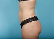 After Image: Abdominoplasty - left-side