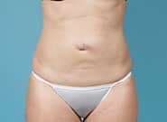 Before Image: Abdominoplasty - front
