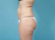 Before Image: Abdominoplasty - left-side