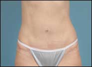 After Image: Abdominoplasty with umbilical hernia repair - front