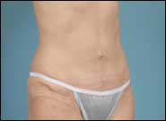 After Image: Abdominoplasty with umbilical hernia repair - right-front-oblique