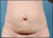 Before Image: Abdominoplasty with umbilical hernia repair - front
