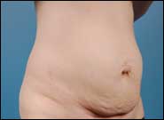 Before Image: Abdominoplasty with umbilical hernia repair - right-front-oblique