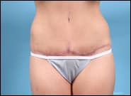 After Image: Abdominoplasty for Rectus Diastasis - front