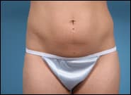Before Image: Abdominoplasty for Rectus Diastasis - front