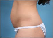 Before Image: Abdominoplasty for Rectus Diastasis - left-side