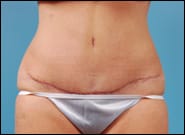 After Image: Abdominoplasty - front