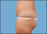 After Image: Abdominoplasty - front