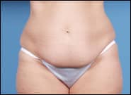 Before Image: Abdominoplasty - front