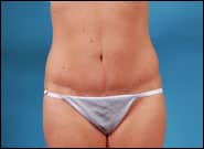 After Image: Abdominoplasty with Repair Rectus Diastasis - front