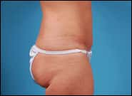 After Image: Abdominoplasty with Repair Rectus Diastasis - right-side