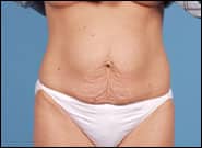 Before Image: Abdominoplasty with Repair Rectus Diastasis - front