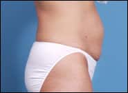 Before Image: Abdominoplasty with Repair Rectus Diastasis - right-side
