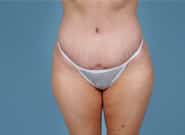 After Image: Standard & Vertical Abdominoplasty - front