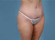 After Image: Standard & Vertical Abdominoplasty - right-front-oblique