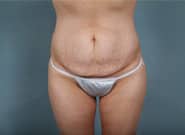 Before Image: Standard & Vertical Abdominoplasty - front