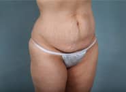 Before Image: Standard & Vertical Abdominoplasty - right-front-oblique
