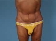 After Image: Abdominoplasty - front