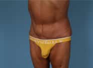 After Image: Abdominoplasty - left-front-oblique