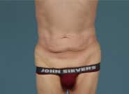 Before Image: Abdominoplasty - front