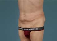 Before Image: Abdominoplasty - left-front-oblique