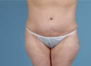 After Image: Standard & Vertical Abdominoplasty - front