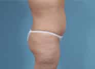 After Image: Standard & Vertical Abdominoplasty - right-side