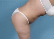 After Image: Standard & Vertical Abdominoplasty - right-side