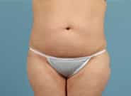Before Image: Standard & Vertical Abdominoplasty - front