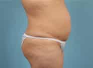 Before Image: Standard & Vertical Abdominoplasty - right-side