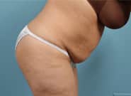 Before Image: Standard & Vertical Abdominoplasty - right-side