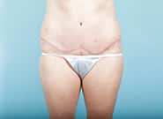 After Image: Abdominoplasty - front