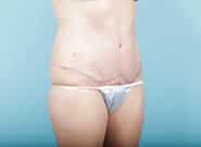 After Image: Abdominoplasty - right-front-oblique