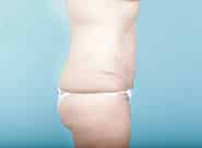 After Image: Abdominoplasty - right-side