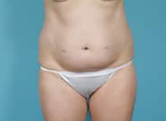 Before Image: Abdominoplasty - front