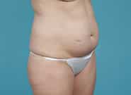 Before Image: Abdominoplasty - right-front-oblique