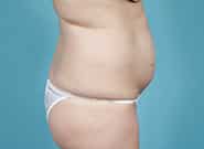 Before Image: Abdominoplasty - right-side